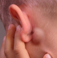 почему воспаляются лимфоузлы за ушами