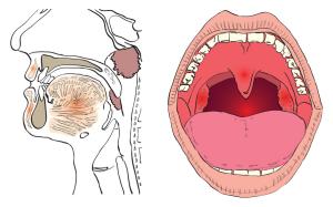 Cимптомы рака горла и гортани