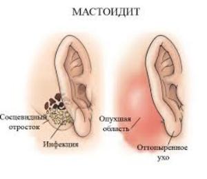 Отогенные осложнения уха