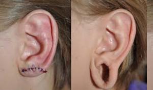 Последствия неправильного прокола хряща уха