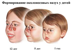 хронический синусит у ребенка симптомы