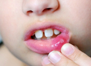 Симптомы и лечение cтоматита у детей