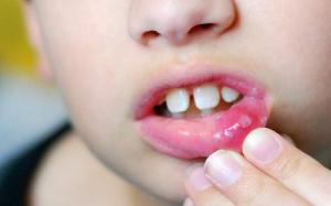Лечение афтозного стоматита у детей