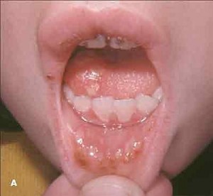 Декубитальная язва в полости рта