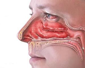 Полипы в носу симптомы и лечение