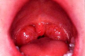 миндалины в горле воспаление