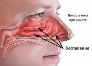 воспаление слизистой носа