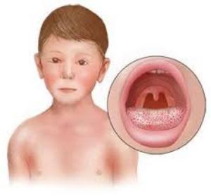 инфекционный мононуклеоз у детей