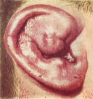 экзостозы наружного слухового прохода