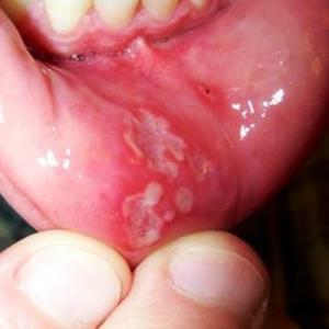 лечение кандидоза полости рта у взрослых