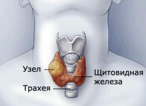 коллоидный зоб щитовидной железы лечение народными средствами