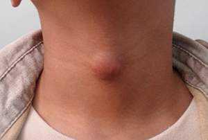щитовидная железа заболевания у мужчин симптомы